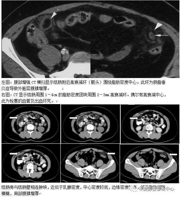 收藏這38個腹部影像征像，每天都用得著