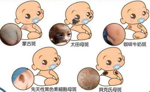 嬰幼兒各種胎記和斑痣解析大全，建議家長收藏