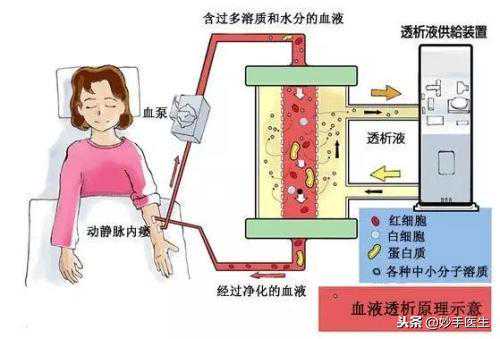 得了尿毒癥，透析和換腎哪個(gè)存活期更長(zhǎng)？收藏轉(zhuǎn)發(fā)！